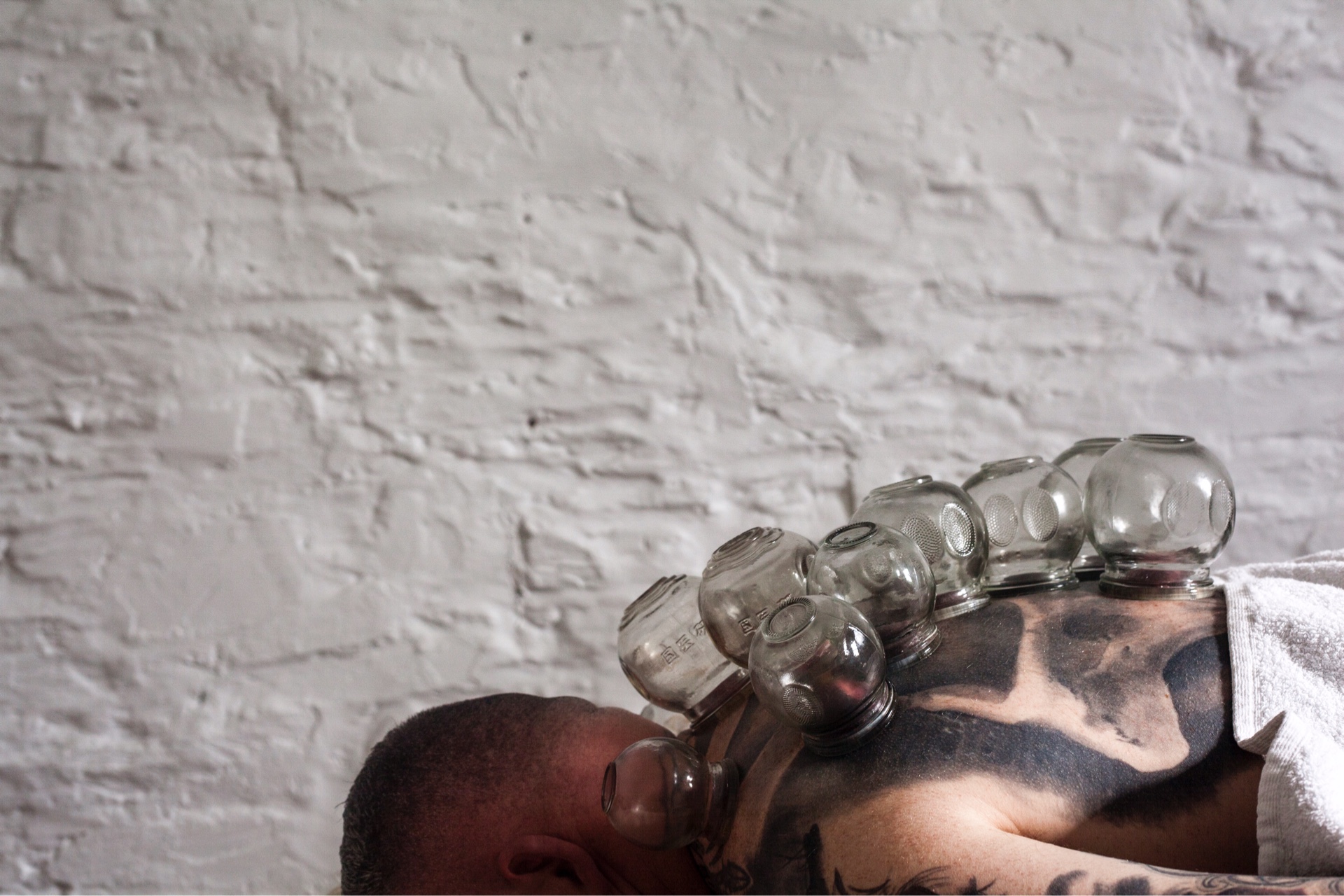 Eastern medicine on the back of the body through cupping.