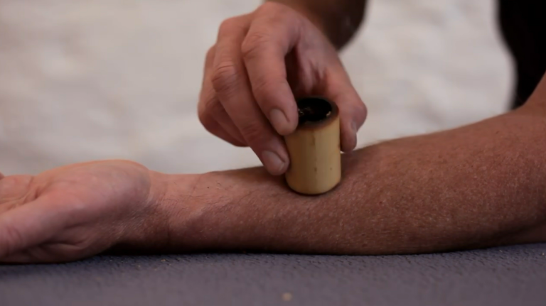 bamboo moxibustion technique